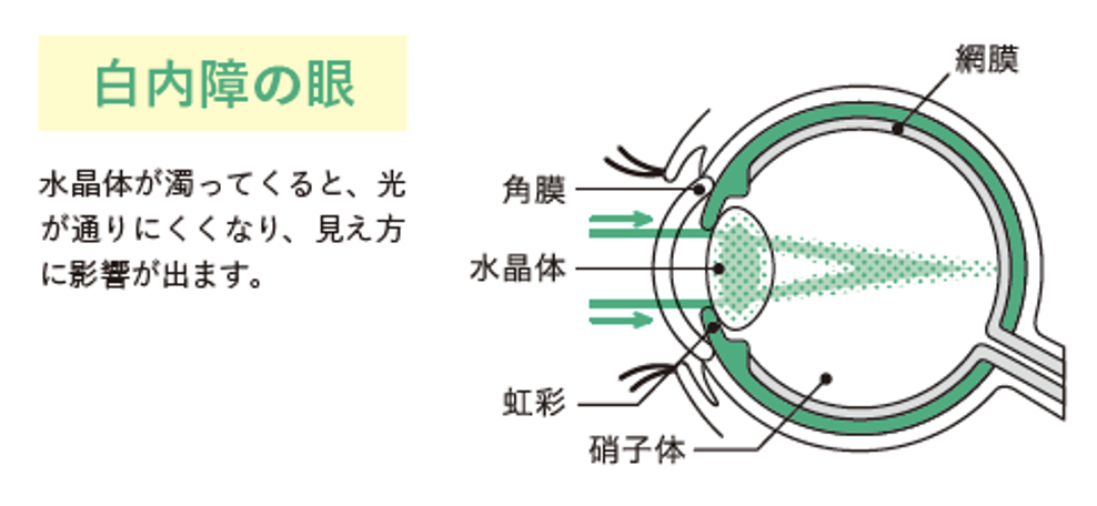 後嚢下白内障